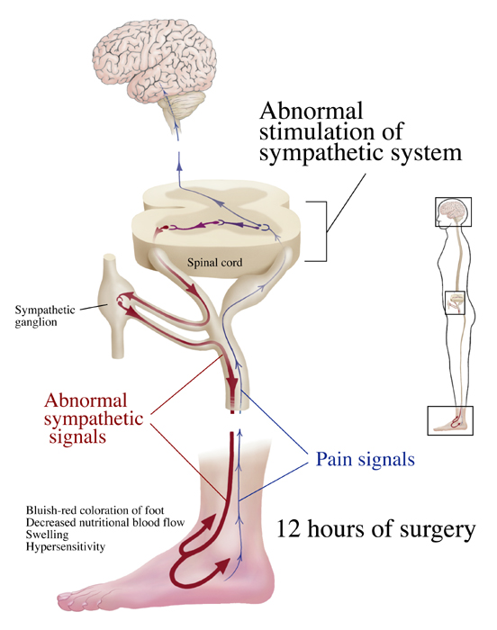 Abnormal Sympathetic Nerve Signals